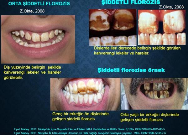 Florozis'in dişe etkilerini gösteren görsel