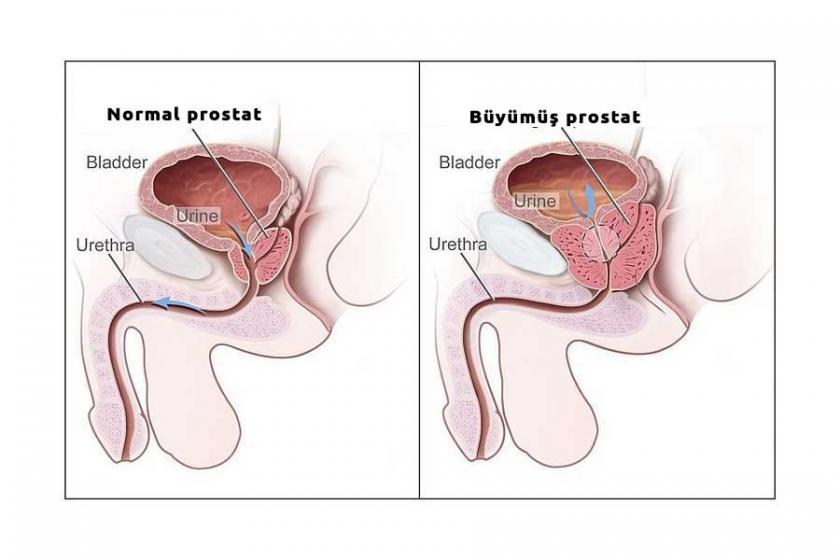 ‘İyi huylu prostat büyümesinin tedavisi mümkün’
