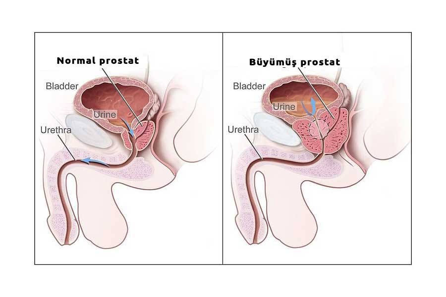 ‘İyi huylu prostat büyümesinin tedavisi mümkün’