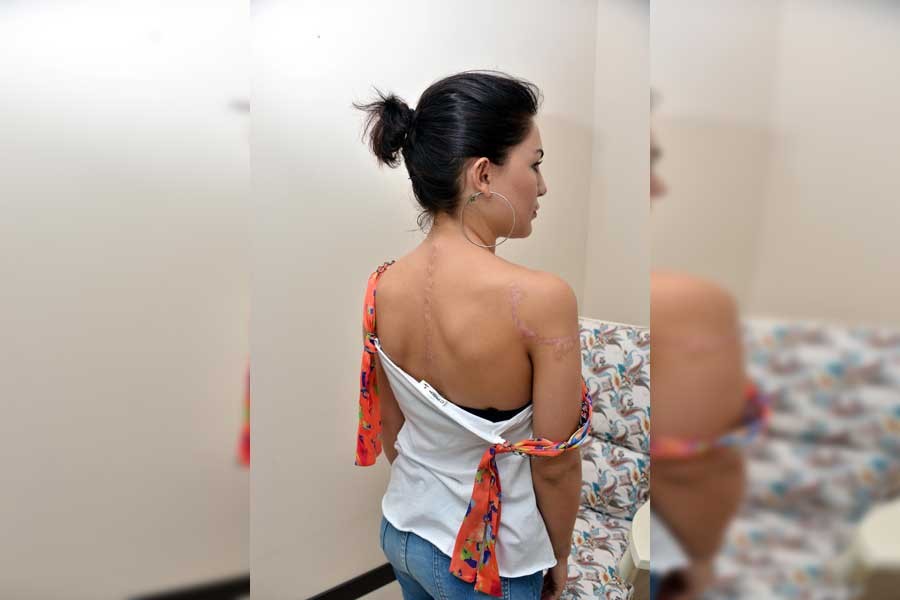 Yanlış dövme silme ameliyatı kadının vücudunda iz bıraktı